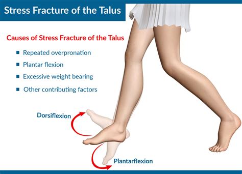 Stress Fracture Of The Talus Causes Symptoms Treatment Surgery Rehab