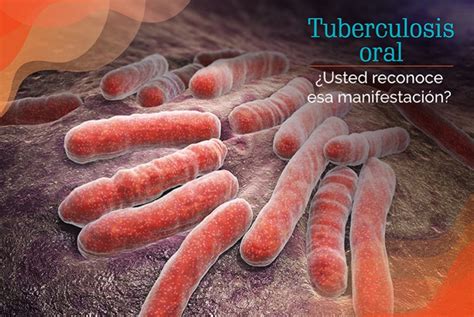 Tuberculosis Oral ¿usted Reconoce Esa Manifestación Blog