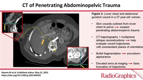 Ct Of Penetrating Abdominopelvic Trauma Radiographics