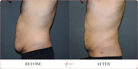 Male Tummy Liposuction View Before And After Photos
