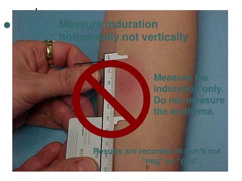 Ppt Intradermal Injections And Interpretation Of Mantoux Tests