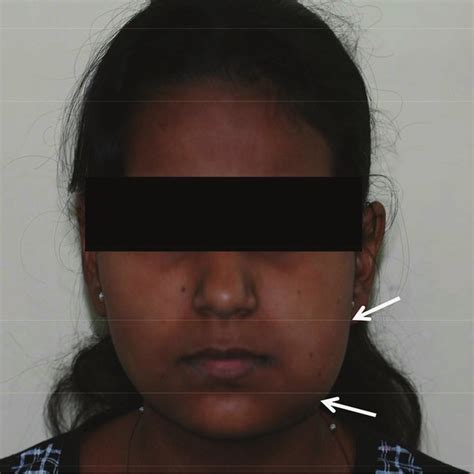 Extraoral Photograph Showing Diffuse Swelling On Left Side Of The