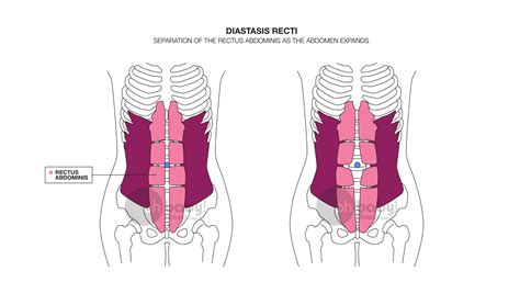 The location of a diastasis and the corresponding measurements can vary, depending on how your breathing, bracing, and pressure management system works and also how areas above (shoulders) and below (hips) function. How to Prevent Diastasis Recti During Pregnancy - Diary of ...