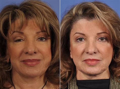 How to clean eyelids after eyelid surgery. Droopy Eyelids - Ptosis Surgery, Eyelid Revision Surgery ...