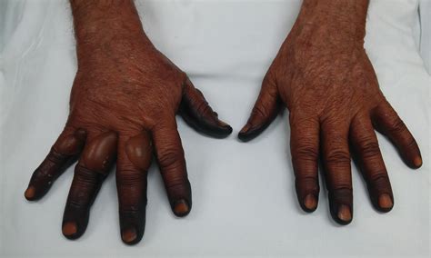 Discoloration And Bullous Lesions On The Hands Mdedge Dermatology
