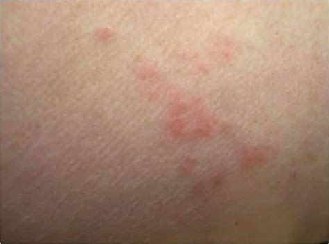 Flea Bites On Humans Pictures Tips Nextgen Pest Solutions