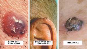 What Does Skin Cancer Look Like? A Visual Guide to Warning Signs - Allure Skin Cancer  