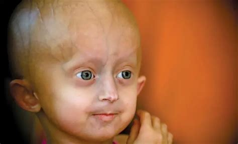 Progeria Syndrome Types Causes And Symptoms