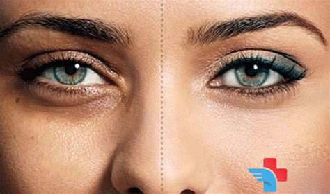 How To Get Rid Of Dark Skin Below Eyes