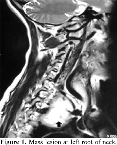 Figure 1 From Misdiagnosis Of Brachial Plexus Schwannoma As Cervical