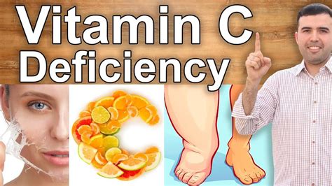 Vitamin C Deficiency Causes Symptoms And Treatment Vrogue Co
