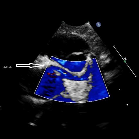 Parasternal Short Axis Image With Color Doppler Demonstrating