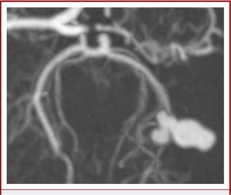 Figure 1 From Dissecting Aneurysms Of The Posterior Cerebral Artery