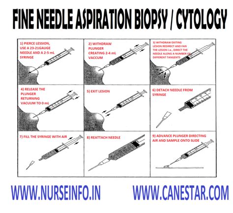 Fine Needle Aspiration Biopsycytology Nurse Info