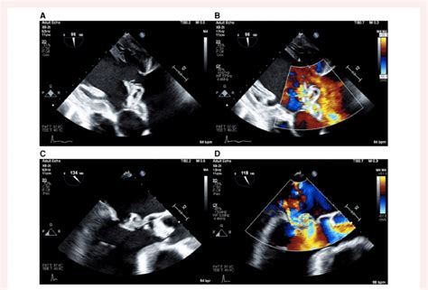 Transesophageal Echocardiogram Aortic And Mitral Valve Endocarditis
