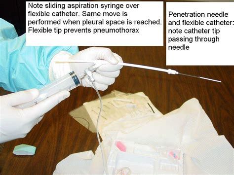 Clinical Notes Thoracentesis A Step By Step Procedure Guide With Photos