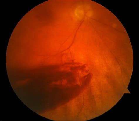 Vitreous Hemorrhages Retina Consultants Of Michigan