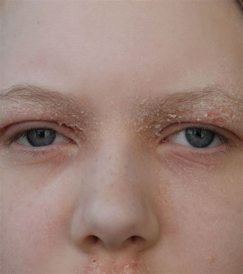 Dry Eyelids Causes Symptoms And Treatment