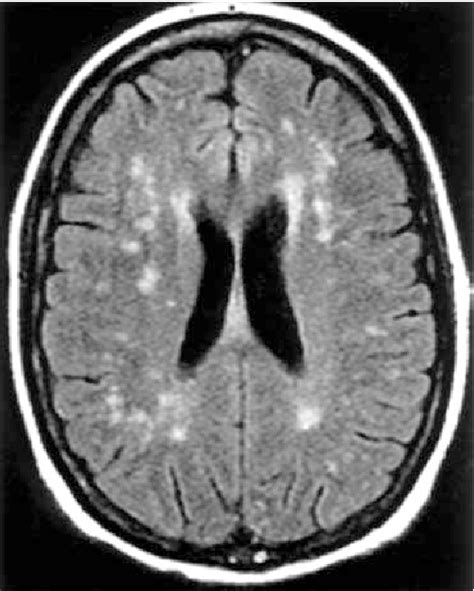 Pdf Value Of Mri Of The Brain In Patients With Systemic Lupus