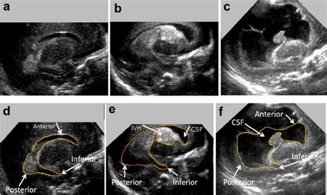Two Dimensional Sagittal Views Of Three Preterm Neonates With Ivh In