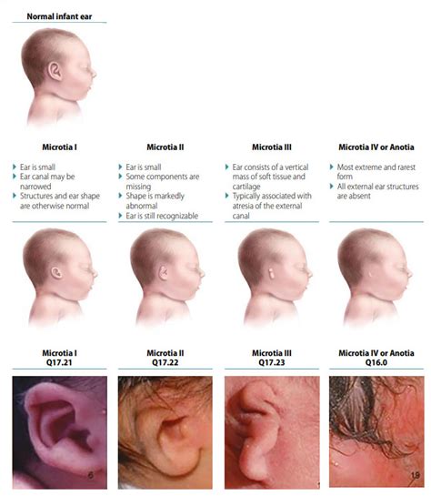 Congenital Anomalies Of The Ear Microtiaanotia Ncbddd Cdc