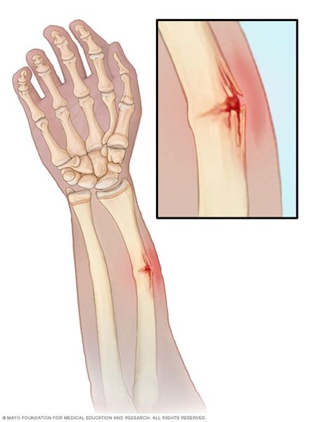 Greenstick Fracture Mayo Clinic