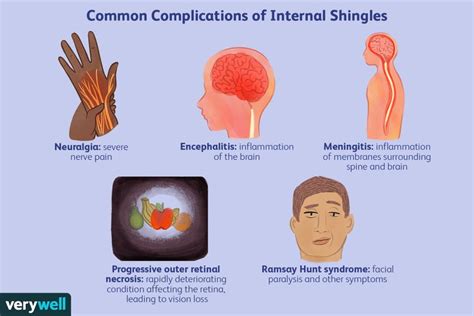 What Is Internal Shingles