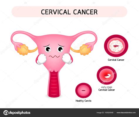 Cervical Cancer Diagram With Sadness Uterus Cartoon Character Stock Vector By ©wowow 163924048