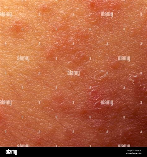 La Dermatite Atopique Ecz Ma Peau Texture D Tail Sympt Me Photo Stock