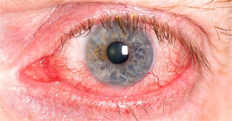Diabetes And Eye Complications What You Need To Know The Diabetes