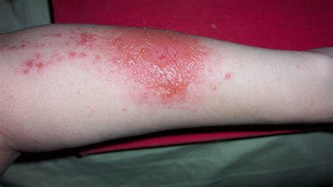 The Triggers Of Systemic Contact Dermatitis