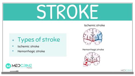 Stroke Definition Classification Causes Symptoms Diagnosis And