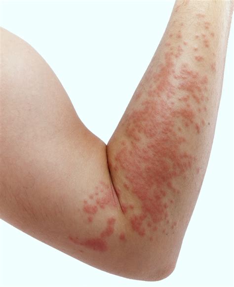 What Causes Hives Your Body Can Heal