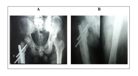 Case 1 Radiographic Images Of The Pelvis In Anteroposterior View A