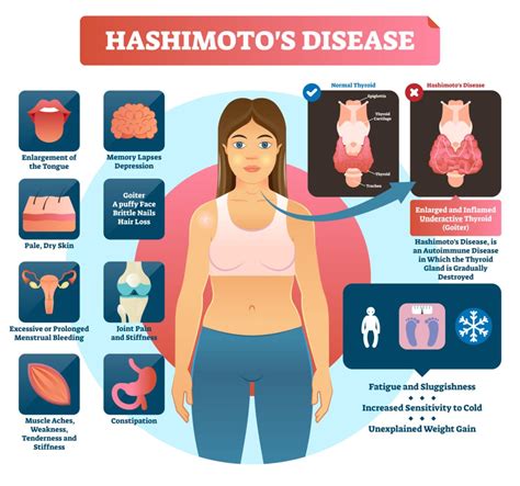 Síndrome De Hashimoto Alimentação