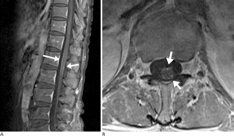 The Usefulness Of Lumbar Spine Mri For Cauda Equina Syndrome