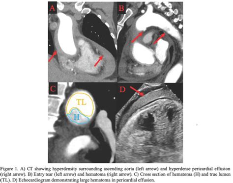 Beyond The Obvious Acute Aortic Dissection Presenting As Cardiac