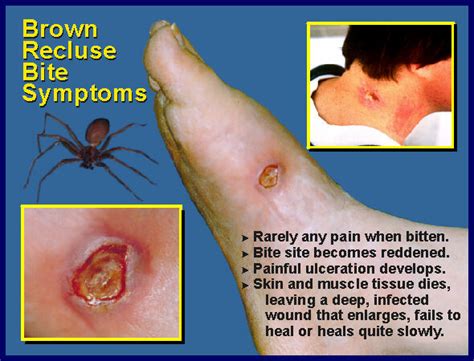Brown Recluse Bite Stages Symptoms Diagnosis Treatmen