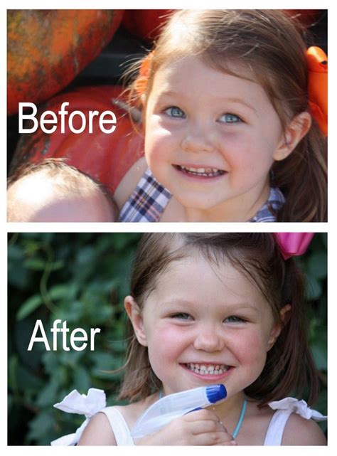 Is it possible to reverse cavities or to reverse tooth decay? How To Reverse Tooth Decay - My Daughter's Story | Teeth ...