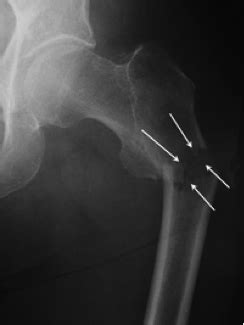 Based on displacement distance of the lesser trochanter and whether the lesser trochanter was reduced operatively, patients were. Hip Fracture-clone - PJS