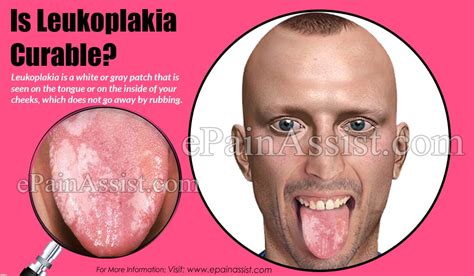 This risk is assessed by examining. Is Leukoplakia Curable?