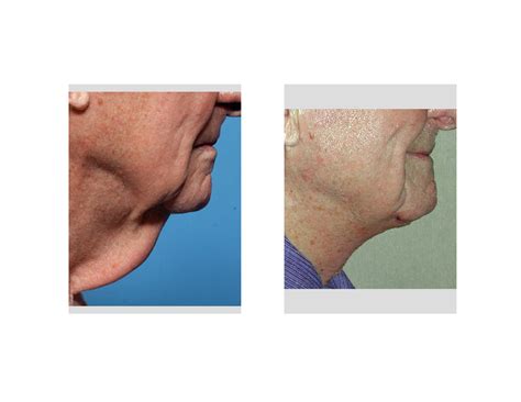 The Direct Neck Lift Scar What Does It Look Like Explore Plastic