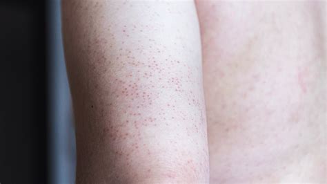 Bump Chicken Skin Back To The Coop How To Treat Keratosis Pilaris