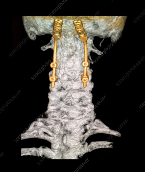 Occipital Cervical Fusion 3d Ct Stock Image C0430218 Science
