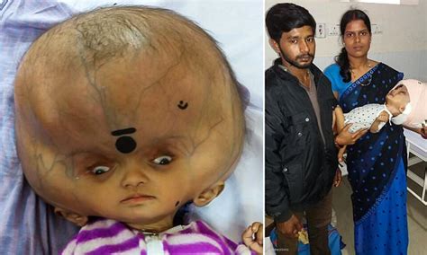 Boy With Worlds Largest Head Has Surgery To Remove Fluid From Around