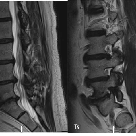 Preoperative T Weighted Lumbar Spine MRI Of Case Demonstrating Download Scientific Diagram