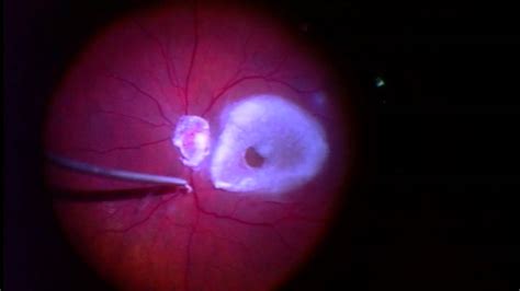 Inducing A Pvd Posterior Vitreous Detachment During Fov Floater Only