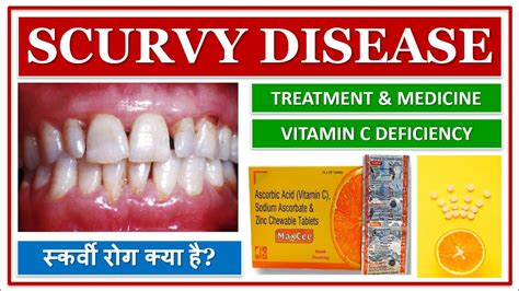 Scurvy Disease स्कर्वी रोग क्या है Vitamin C Deficiency Sign