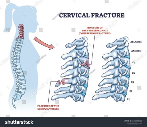15 Fractured Spinous Process Cervical Vertebrae Images Stock Photos