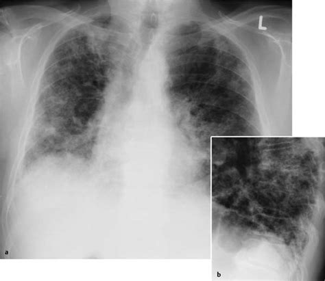 Fibrosing Lung Disease Radiology Key
